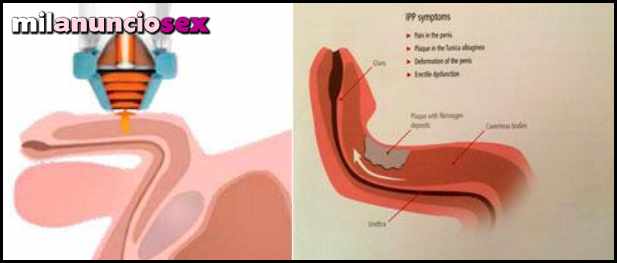 FISIOTERAPIA UROLOGICA